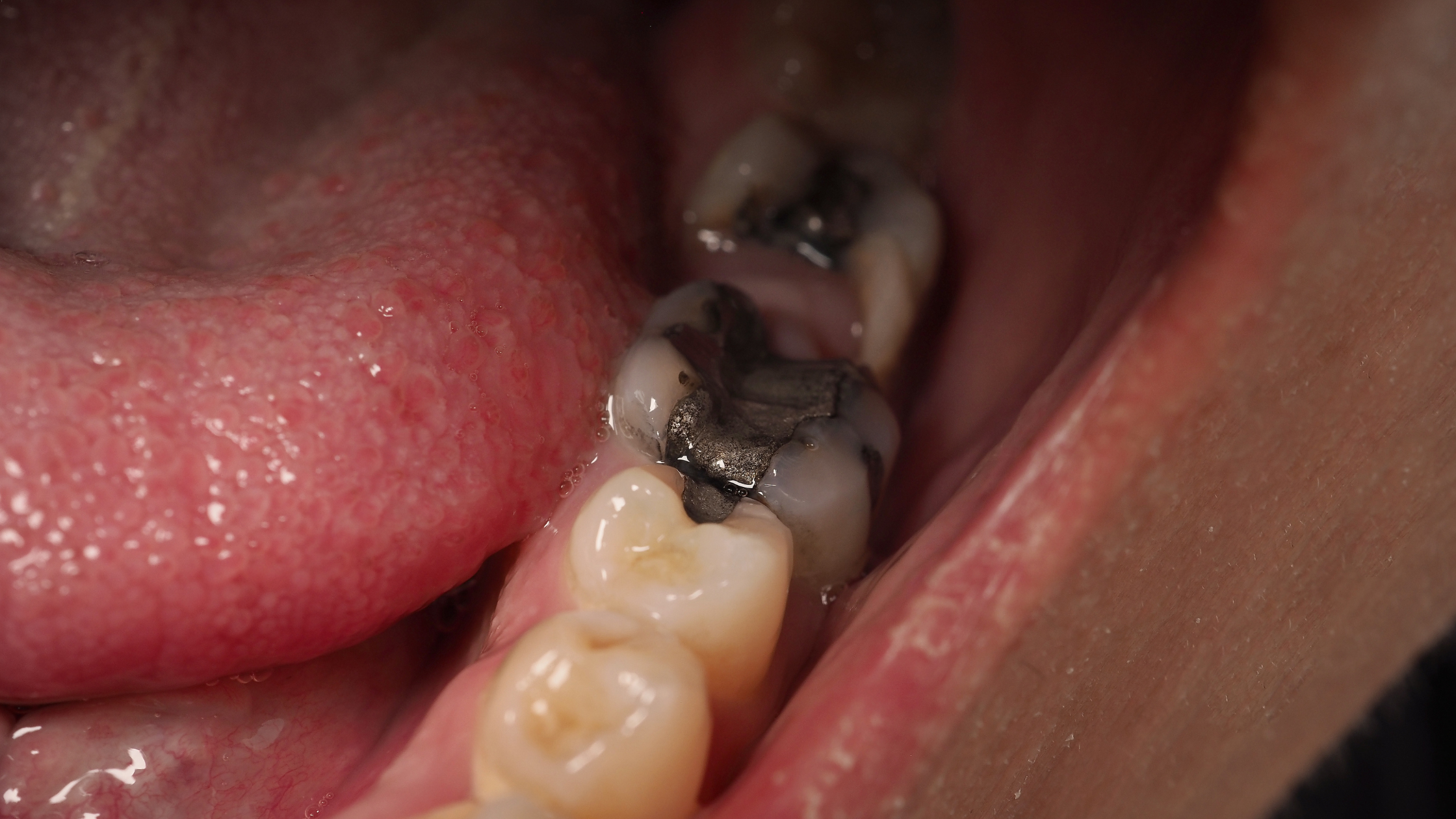 An image of dental amalgam fillings